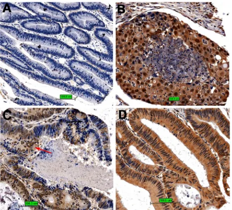 Figure 7: The relationship between MTA1 and cancer differentiation. A. Cancer tissue is well differentiated with little MTA1 expression; B, The cancer tissue is poorly differentiated with high nuclear MTA1 expression; C, Different regions with different nuclear MTA1 expression in colon cancer tissue show different differentiation states; D, The cancer tissue is well differentiated with high cytoplasmic but low nuclear MTA1 expression.