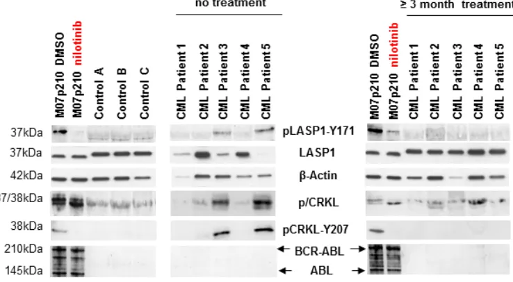 Figure 1: LASP1 is overexpressed in CML and phosphorylated at Tyr‑171 in leukemia cell lines
