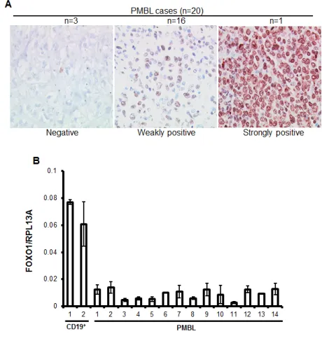 Figure 1: FOXO1 is downregulated in PMBL. (A) High-magnification images show differential FOXO1 expression in malignant cells of PMBL (original magnification ×200)