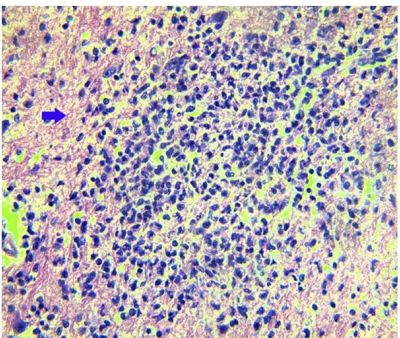 Figure 4. Glial nodule in spinal cord of fatal Hand, Foot and Mouth Disease. HE staining, × 400