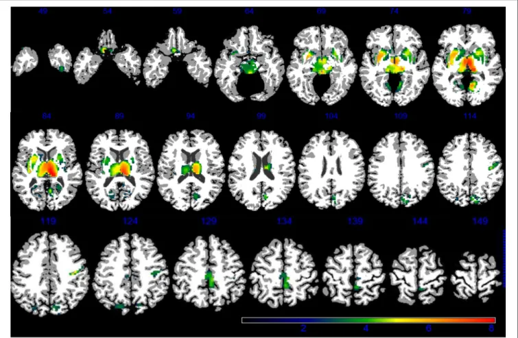 FIGURE 3 | GM areas positively associated to PM 2.5 (q < 0.05 FDR corrected) according to VBM linear regression are presented in color