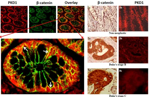 Figure 1: Expression of PKD1 is downregulated in colon cancer. (A)in colon tissues:cytoplasm and membrane of colon cells, while β-catenin was primarily localized to the membrane