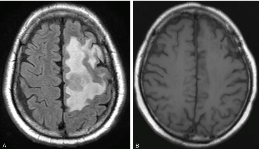 Figure 3. Brain MRI (T1 FLAIR). A. Before treatment: a mass measuring 3.5 cm in diameter and edema were seen in the left cerebral white matter at the level of the centrum semiovale