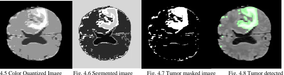 Fig. 4.3 Filtred input for EM-GM Segmentation              Fig 4.4 EM-GM segmented image 