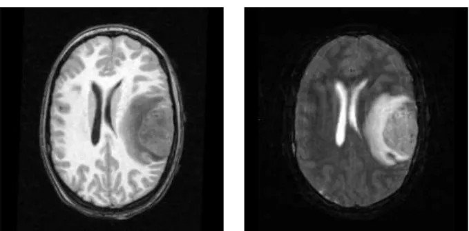 Figure 3.7. The T1 image (left) and the T2 image (right) from the Tu- Tu-mor020 data. The tumor and edema on the right part of the brain can be clearly differentiated based on the T2 intensities