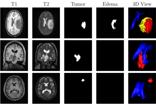 Figure 3.9. The datasets and the generated segmentation results. The last column shows the 3D views of the segmented structures: red represents tumor, yellow represents edema, and blue represents ventricles