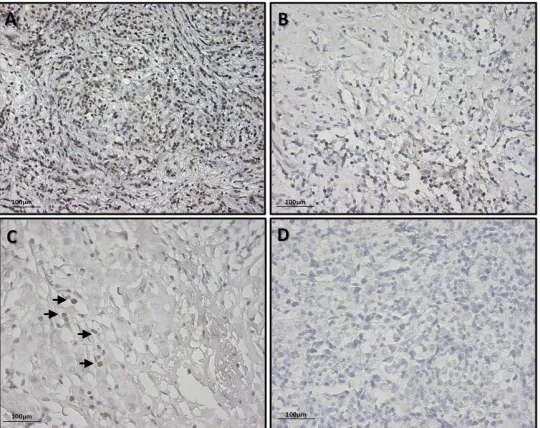 Figure 5: Exemplificative pictures of immunohistochemical staining of SOX2 showing different expression levels in BC tissues