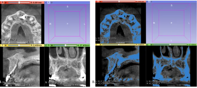 Figure 1.  A)  Represents the pre-segmented image when loaded into 3D-Slicer.  B)   Represents the results of the auto-segmentation by the Intensity Segmenter module of  3D-Slicer