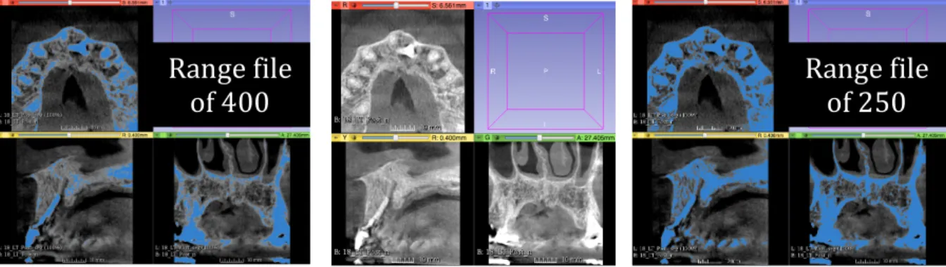 Figure 2.  These pictures illustrate the different segmentations that can occur with the use of  different range files of varying Hounsfield units