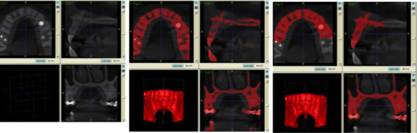 Figure 4.  This figure represents the full process of automatic segmentation via ITK-Snap