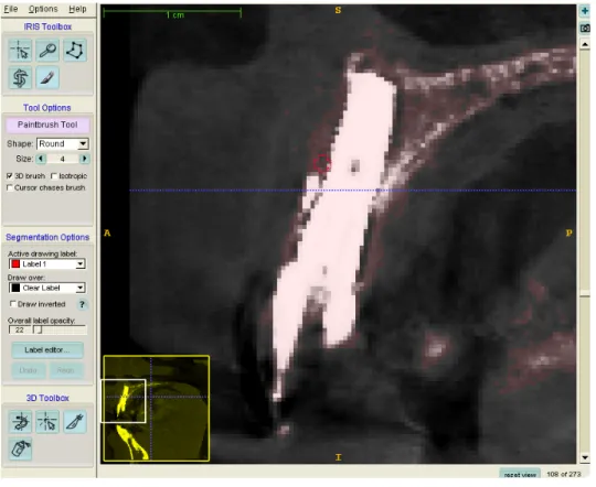 Figure 5.  After automatic segmentation via ITK-Snap is accomplished, the file is then  further segmented by hand via the paintbrush tool (illustrated above)