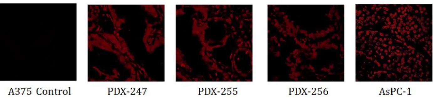 Figure 2.5 Immunohistochemistry studies on the binding of TAMRA-labeled 1502 to PDX tissue samples of  pancreatic ductal adenocarcinoma