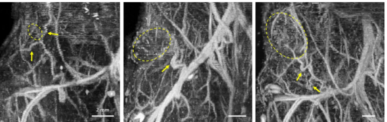 Figure 4.8: These maximum intensity projections in the coronal plane illustrate three tumors with tortuous vasculature outside of the tumor margin
