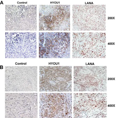 Figure 2.2: HYOU1 is expressed in tissue from KSHV-associated tumors. (A) 