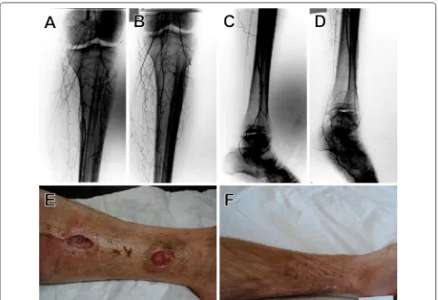 Fig. 1 Collateral vessel formation and ulcer healing after SVF cell therapy. Case 1: digital subtraction angiography (DSA) images before (A, C) and after SVF cell injections (B, D)