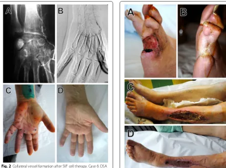 Fig. 2 Collateral vessel formation after SVF cell therapy. Case 6: DSA images before (A) and 10 months after SVF cell injections (B)