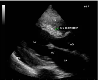 Figure 13. Showing the IVS (interventricular septum) calcification in effusive-constrictive pericarditis as evidenced by mild pericardial effusion (PE) with an associated disease of Endomyocardial fibrosis