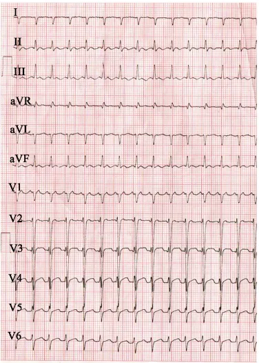 Figure 1. ECG showing tachycardia (rate 150 bpm) in a 67 year old male with “end-stage” constrictive pericarditis