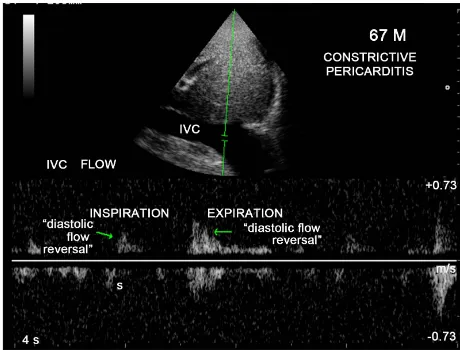 Figure 7. M-mode LV study showing the “septal notch” and “dip and flattening” of LV posterior wall