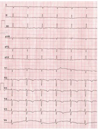 Figure 12. ECG—Rhythn is normalizing on continuation of verapamil. 