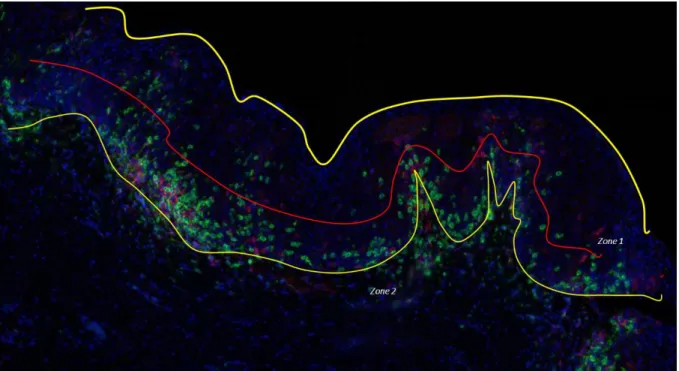 Figure 4.  Example of analysis of distribution of CD8+ lymphocytes within epithelium or Zone 1