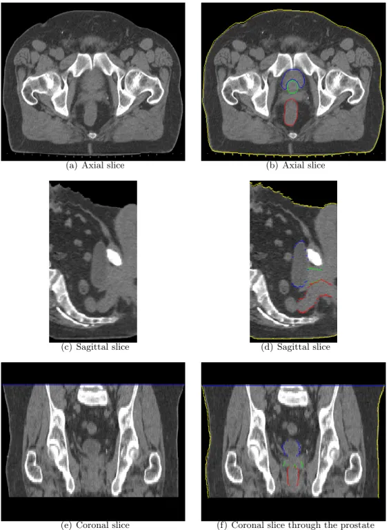 Figure 3.1: Slices through a CT image of the male pelvis are shown. Segmentations of the bladder (blue), prostate (green), rectum (red), and skin (yellow) are shown in Figures 3.1(b), 3.1(d) and 3.1(f ).