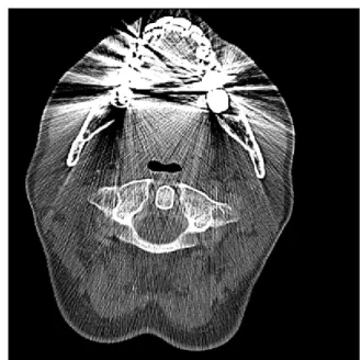 Figure 2.3: Metal streak artifacts in a head and neck CT image