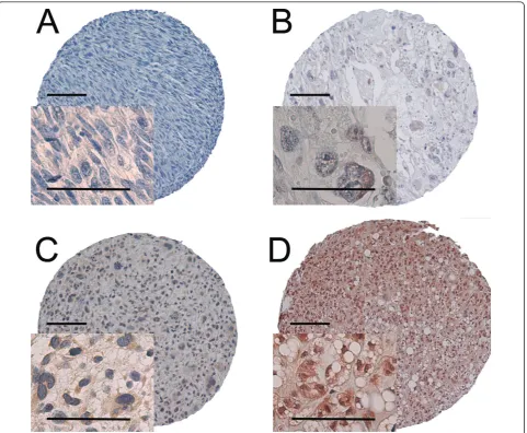 Figure 1 IHC analysis of TMA of non-GIST STS representing different expressions of markers belonging to PI3K/Akt pathway in tumorAbbreviations: IHC, immunohistochemistry; TMA, tissue microarray; non-GIST STS, non gastro-intestinal stromal tumor soft-tissue