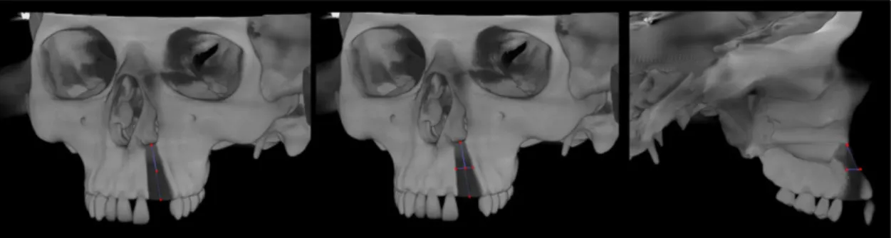 Figure 1 Method 1: measurement of the height, width and facial-palatal length of the cleft in maximum intensity projection.