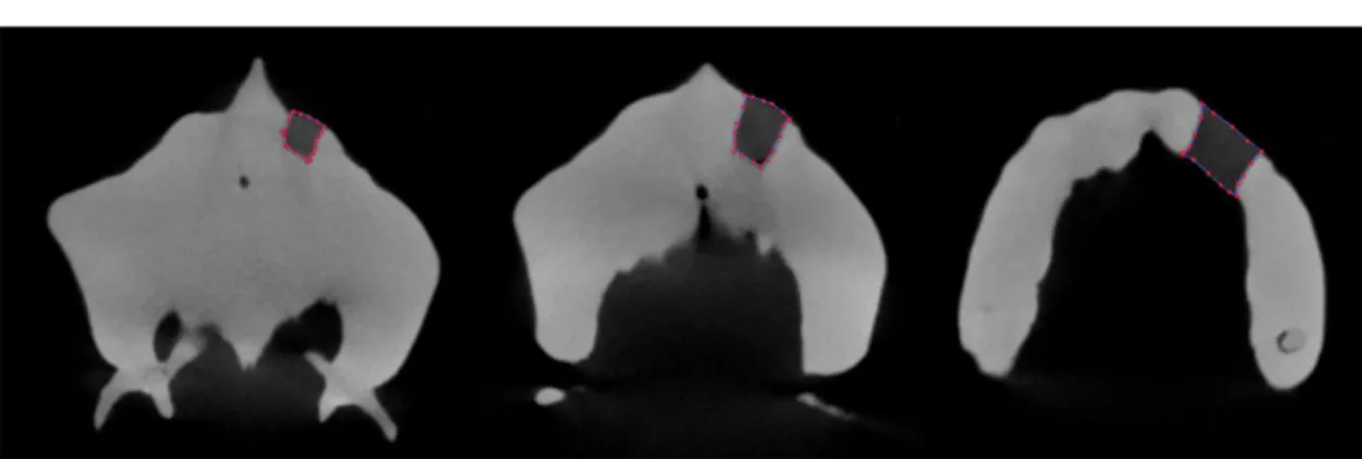 Figure 2 Method 2: measurement of the area of the cleft slice by slice on axial view.