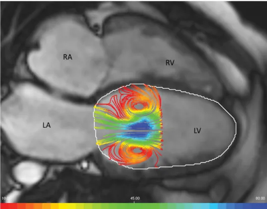 Figure 1.2. 2D view of an early filling vortex ring flow in the left ventricle (LV) visualized  as a pair of counter rotating vortices (left) using streamlines (color coded by velocity  magnitude from red to blue) and superimposed on a four chamber MR card