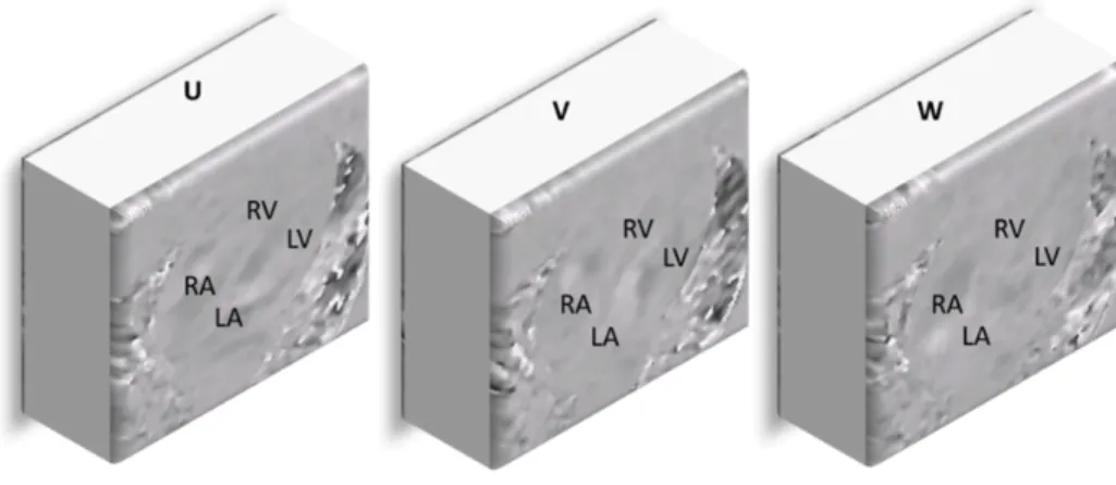 Figure 1.3. Example of reconstructed whole-heart 4D Flow MRI volumes of the three  velocity components (the in-plane ܃ǡ ܄ components and the through-plane ܅ component)