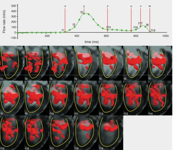 Figure 2.4. time-sequence of the Lambda2-detected 3D LV vortex structures (visualized as  isosurfaces in red color) over all acquired diastolic phases of a sample normal subject, with  E-filling onset (x), peak (y) and end (z), and A-filling onset (u), pea