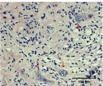 Figure 2. Transplanted heart, right ventricle. Clusters of protozoa, con- con-sistent with T