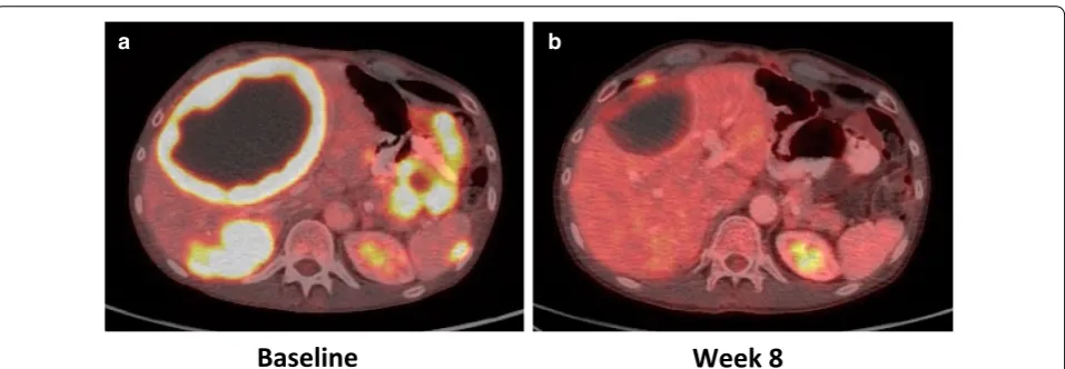 Fig. 4 Radiological response of a GIST possessing an ETV6–NTRK3 fusion following treatment with LOXO‑101, a selective TRK inhibitor