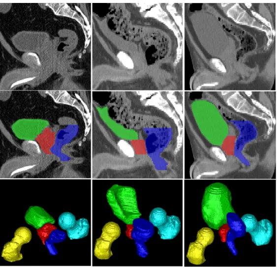 Figure 1.2: Typical CT scan slices and their pelvic organ segmentations. The three columns indicate images from three patients
