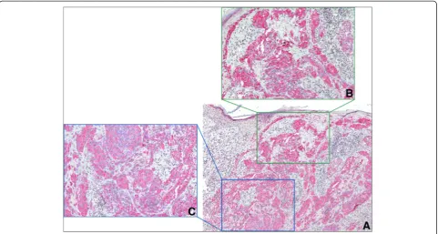Figure 5 HOX C13/HMB-45 double staining IHC in metastatic melanoma tissues. A: Cytoplasm HMB-45 immunopositivity (red) and nuclear HOXC13 immunopositivity (brown) in nodal metastasis (20X); B: Cytoplasm HMB-45 immunopositivity (red) and nuclear HOX C13 immunopositivity (brown)in nodal subcapsular micrometastasis (40X) C: Cytoplasm HMB-45 immunopositivity (red) and nuclear HOX C13 immunopositivity (brown) in dermalmetastasis (40X).