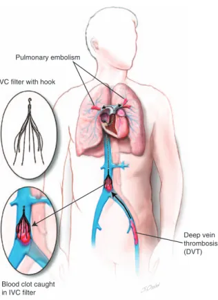 Figure 1. The main image shows a filter in the big vein in the abdomen, preventing a clot  that breaks off a deep vein thrombosis from reaching the lung