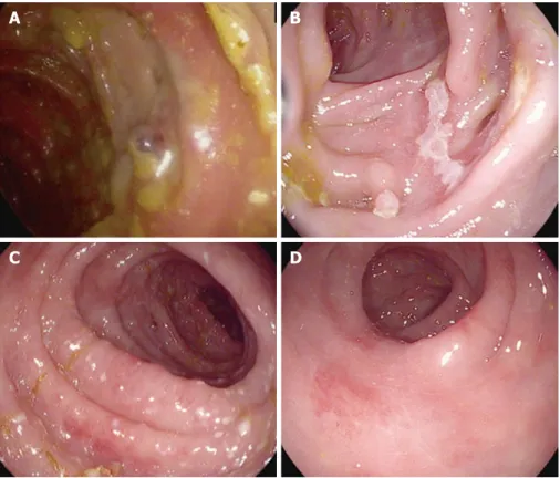 Figure 1  Sample endoscopic images from patients with ipilimumab-mediated enterocolitis