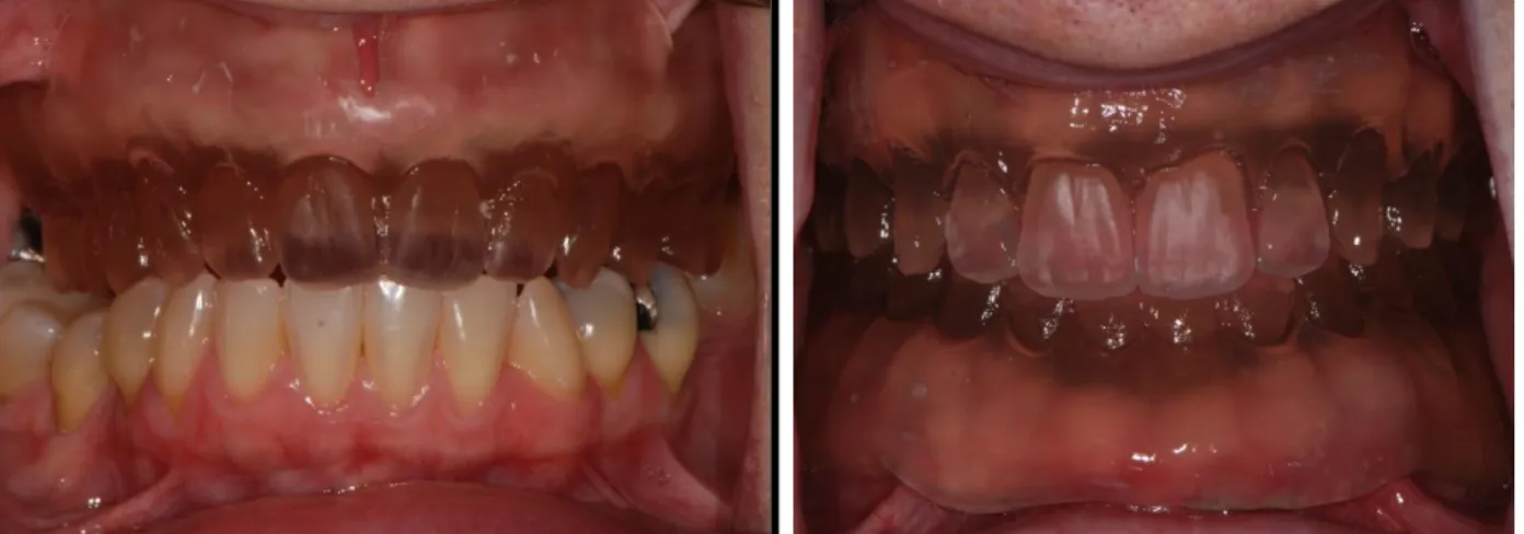 Figure 1.1 a and b. Duplicated maxillary complete denture placed for radiographic/surgical guide in (a) single- single-arch case opposing natural dentition and (b) dual single-arch case