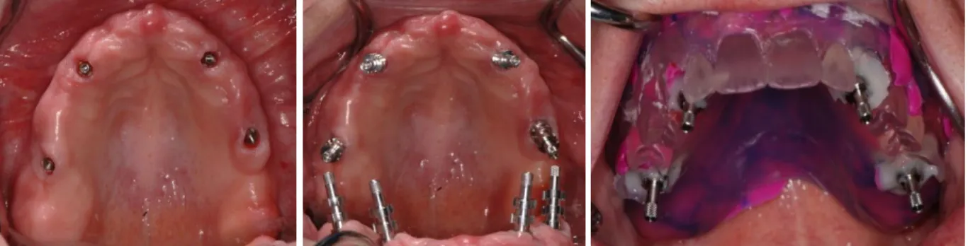 Figure 1.4a-c.  Final impression technique. UniAbutments torqued into implants following second-stage surgery  (a), abutment-level impression pick-ups placed (b), and pick-ups secured into surgical guide washed with PVS (c)