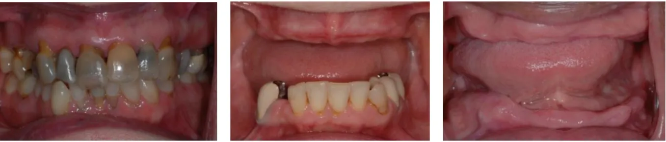 Figure 2.1a-c.  Examples of baseline dentition for included patients: (a) natural teeth with terminal dentition in  the maxilla, (b) existing maxillary edentulous condition opposing at least 5 natural teeth, (c) existing maxillary  and mandibular edentulis