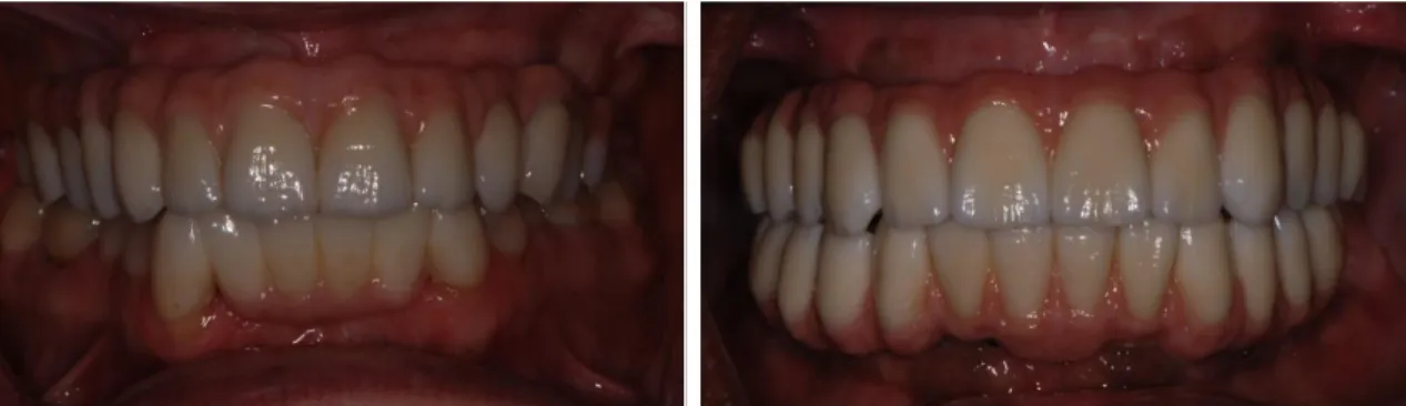 Figure 2.2a and b. Examples of maxillary single arch (a) and dual arch (b) monolithic zirconia implant-supported  fixed dentures