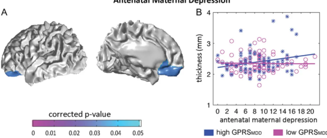 Figure 3. Statistical maps for interaction of the infant GPRS MDD with antenatal maternal depressive symptoms (A) on cortical thickness