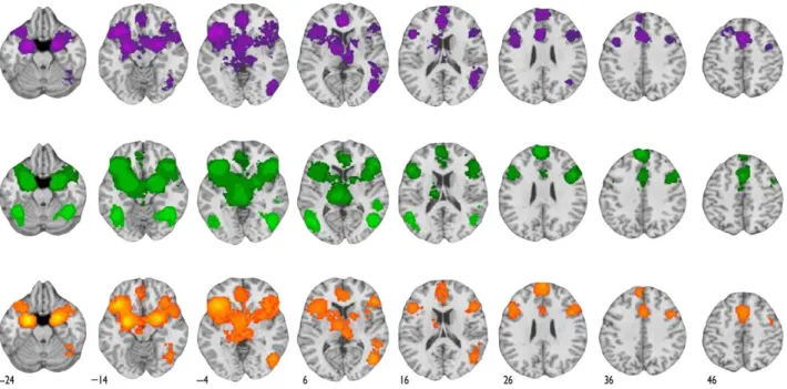 Figure 3. Neural regions exhibiting a preference for negative affect. The ﬁgure shows that portions of the left anterior insula and amygdala extending into the anterior hippocampus exhibited more frequent preference to negative affect among regions already