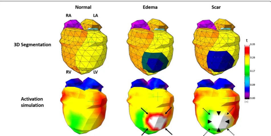 Fig. 4 Feasibility of cardiac activation simulation on customized meshes with pre-defined structural abnormalities