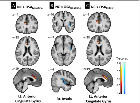 Fig. 2 Regional gray matter volume differences between OSAbaseline and OSAfollow groups