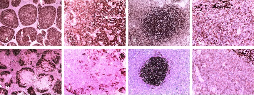 Figure 1. Immunohistochemical staining for follicular dendritic cell immunoarchitectural patterns (FDC patterns) in small B cell lymphoma (SBL) specimens; differences in staining intensity between CD21 and CD23 are shown in slides within a similar region f