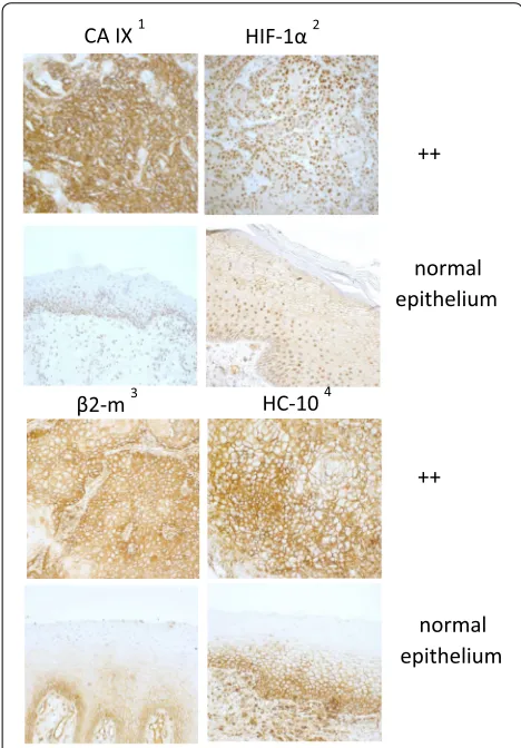 Fig. 4 Differential expression of hypoxia markers and HLA class I beta2-microglobulin in OSCC-carboanhydrase (CA) IX1, hypoxia inducing factor (HIF) 1α2, (β2-m)3 and heavy chain (HC)-104 in human head and neck squamous cell carcinoma (OSCC)