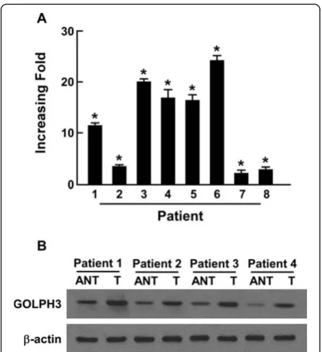 Figure 3 The expression of GOLPH3 protein in oral tongue cancer sections.detectable GOLPH3 staining ( Representative immunohistochemical images of cN0 oraltongue cancer tissue specimens indicating strong GOLPH3 staining (A and B); moderate GOLPH3 staining 